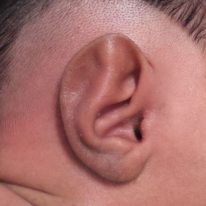 prominent ear